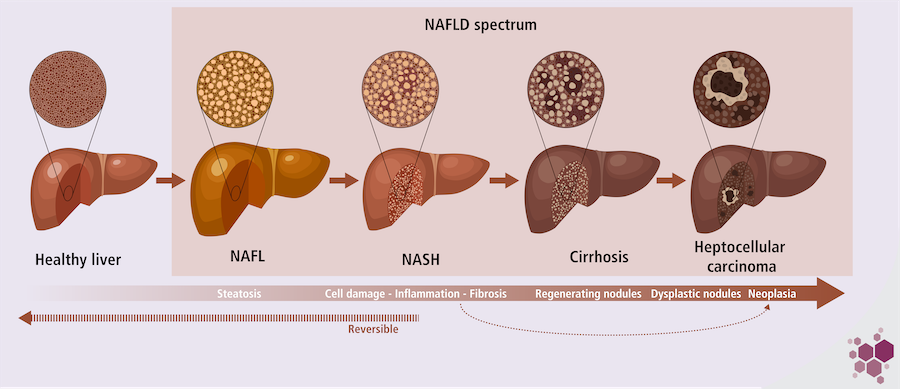 NAFLD Spectrum Chart