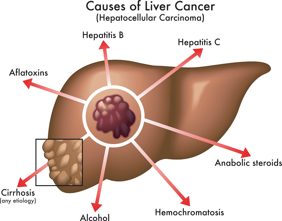 Causes of Liver Cancer